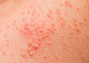 allergic rash